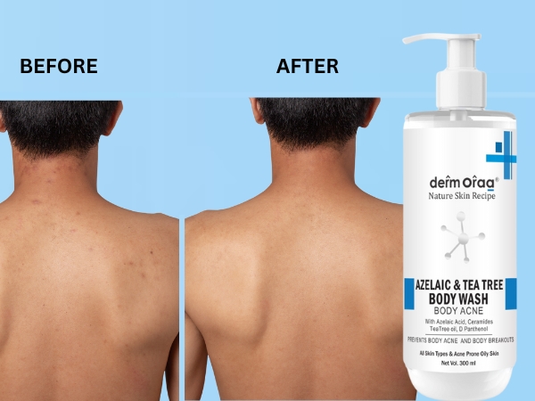 Azelaic & Tea Tree Body Wash for Body Acne | Nature Skin Recipe